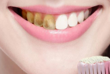 导致牙黄的4种因素 怎样美白