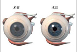 眼角膜移植手术图解